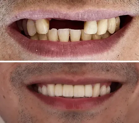 Úsměv s mezerou po chybějícím zubu a tentýž úsměv po nasazení můstku