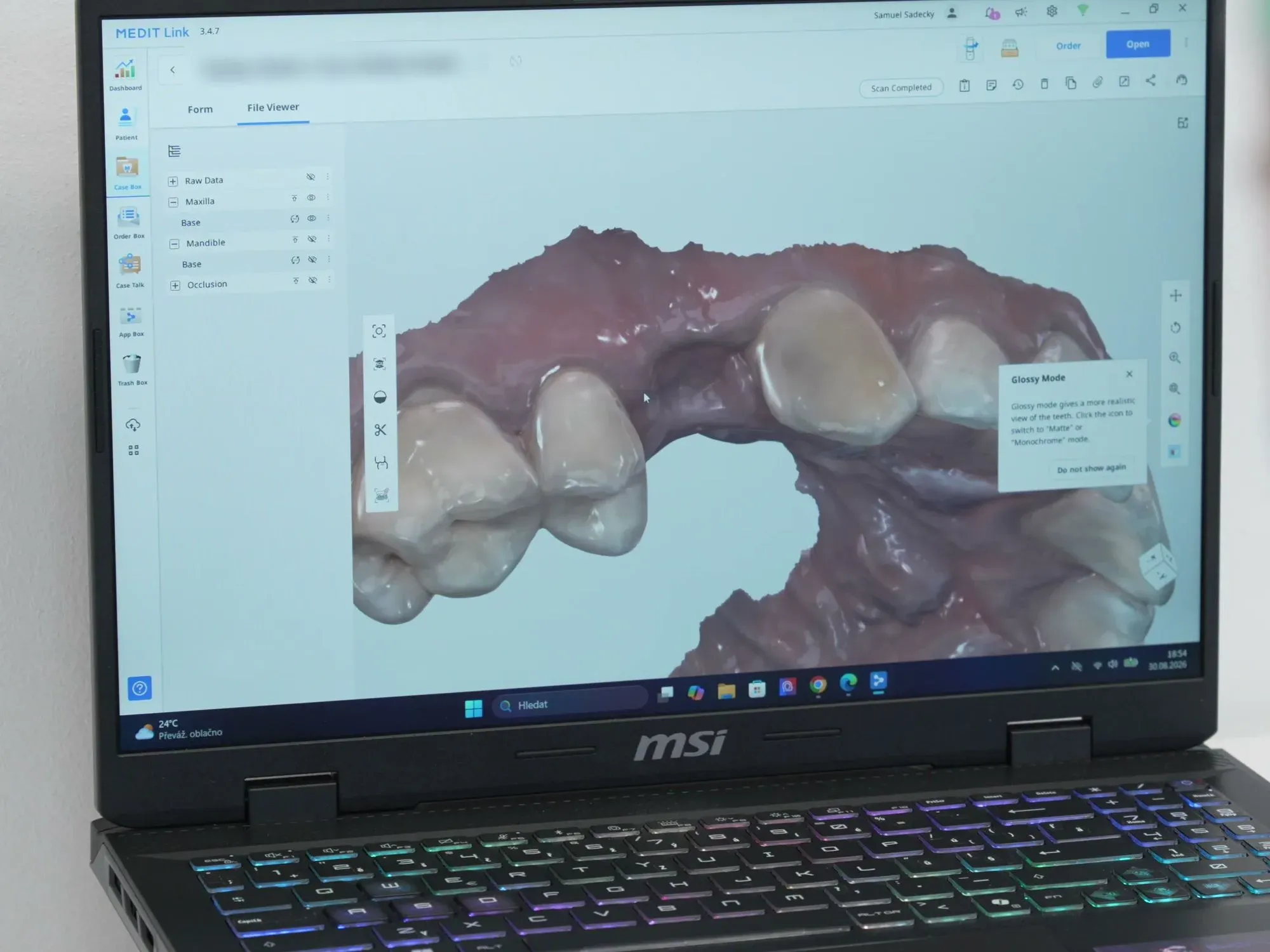 Digitální návrh zubních korunek z intraorálního skeneru na monitoru